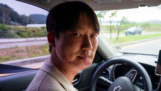 Eui Seok Kang lost half of his lower jaw, most of his lower teeth and some upper teeth. Over the next month, he underwent three surgeries, including for an infection and facial reconstruction.