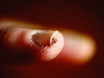 Here’s how to spot nail fungus early before it gets worse.
