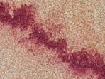 Cyclosporiasis cases are rising across the US. (Pixabay/Representative)(Pixabay)