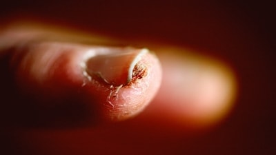 Here’s how to spot nail fungus early before it gets worse. (Unsplash) Here’s how to spot nail fungus early before it gets worse. (Unsplash)