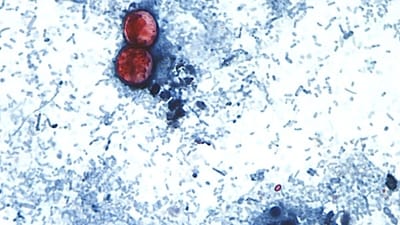 This undated photo taken through a microscope provided by the CDC shows Cyclospora cayetanensis oocysts found in a fresh stool sample which had been prepared with a formalin solution and stained with safranin. (CDC via AP)