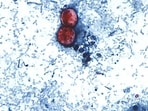 Microscopic image provided by the CDC shows cyclospora cayetanensis oocysts found in a stool sample, which had been prepared with a formalin solution and stained with safranin.