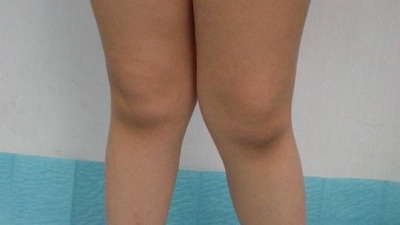 Knock knees in children is a common condition that often resolves on its own with time, notes Dr Virmani. (Pinterest) Knock knees in children is a common condition that often resolves on its own with time, notes Dr Virmani. (Pinterest)