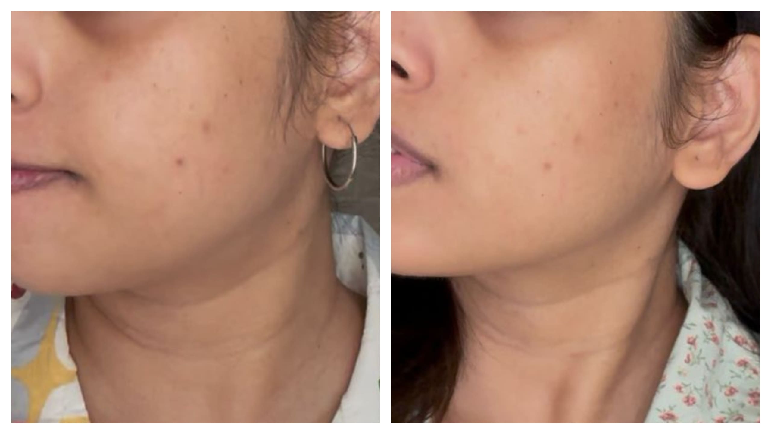 Changes in the skin: Fewer bumps, lighter spots. Changes in the skin: Fewer bumps, lighter spots.