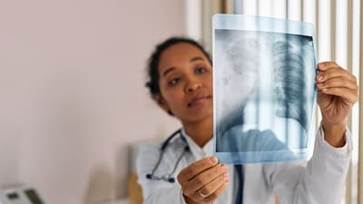 People who have asthma, obstructive pulmonary disease or allergic rhinitis are more likely to get fungal lung infections. (Pexel) People who have asthma, obstructive pulmonary disease or allergic rhinitis are more likely to get fungal lung infections. (Pexel)