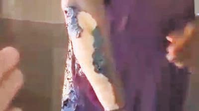 Biker suffers burn injuries during MMRDA pothole repairs Biker suffers burn injuries during MMRDA pothole repairs