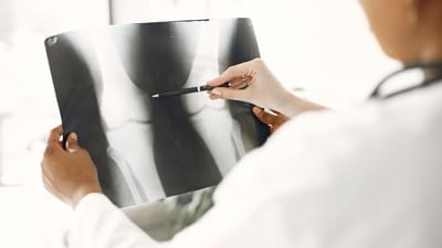 Early diagnosis improves the chances of effective treatment of bone cancer. (Pexel) Early diagnosis improves the chances of effective treatment of bone cancer. (Pexel)