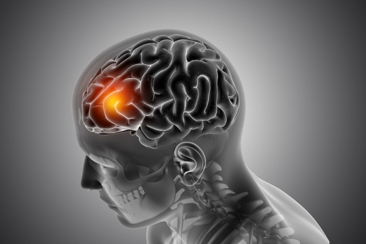 Alzheimer's disease is caused by the abnormal buildup of proteins in and around brain cells. (Picture credit: Freepik) Alzheimer's disease is caused by the abnormal buildup of proteins in and around brain cells. (Picture credit: Freepik)