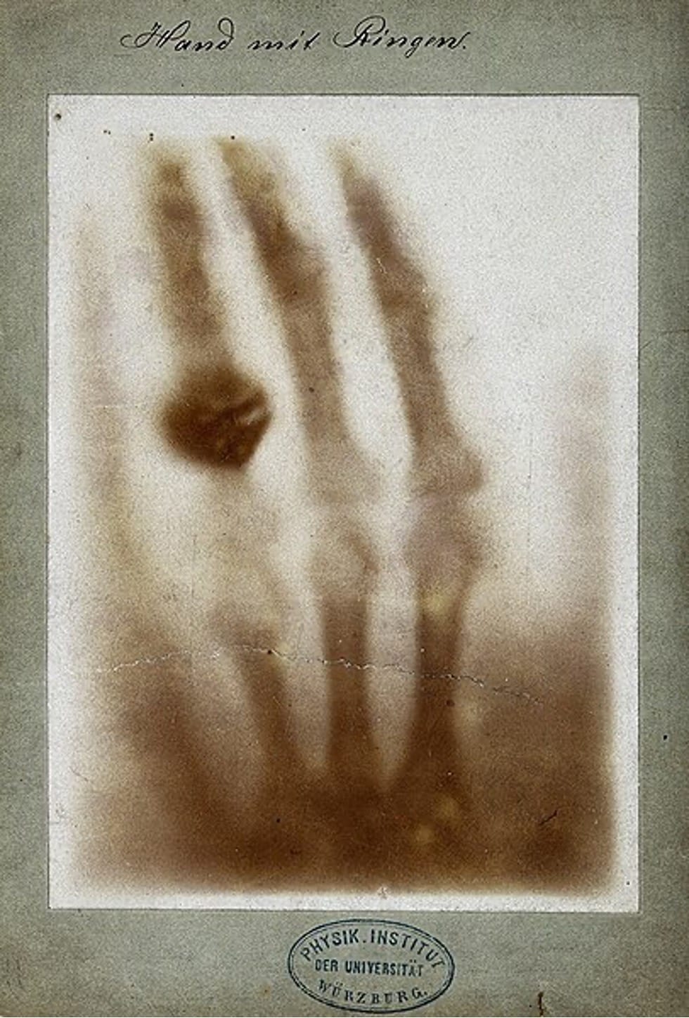 The first X-ray by Wilhelm Röntgen, of his wife’s hand; 1895. I think I have seen my own death, she said. Wikimedia The first X-ray by Wilhelm Röntgen, of his wife’s hand; 1895. I think I have seen my own death, she said. Wikimedia