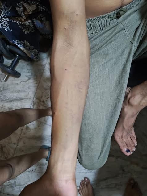 His discharge paper, accessed by HT, reads: “Multiple pellet injuries to the right upper limb, chest and inguinal region.” (HT Photo) His discharge paper, accessed by HT, reads: “Multiple pellet injuries to the right upper limb, chest and inguinal region.” (HT Photo)