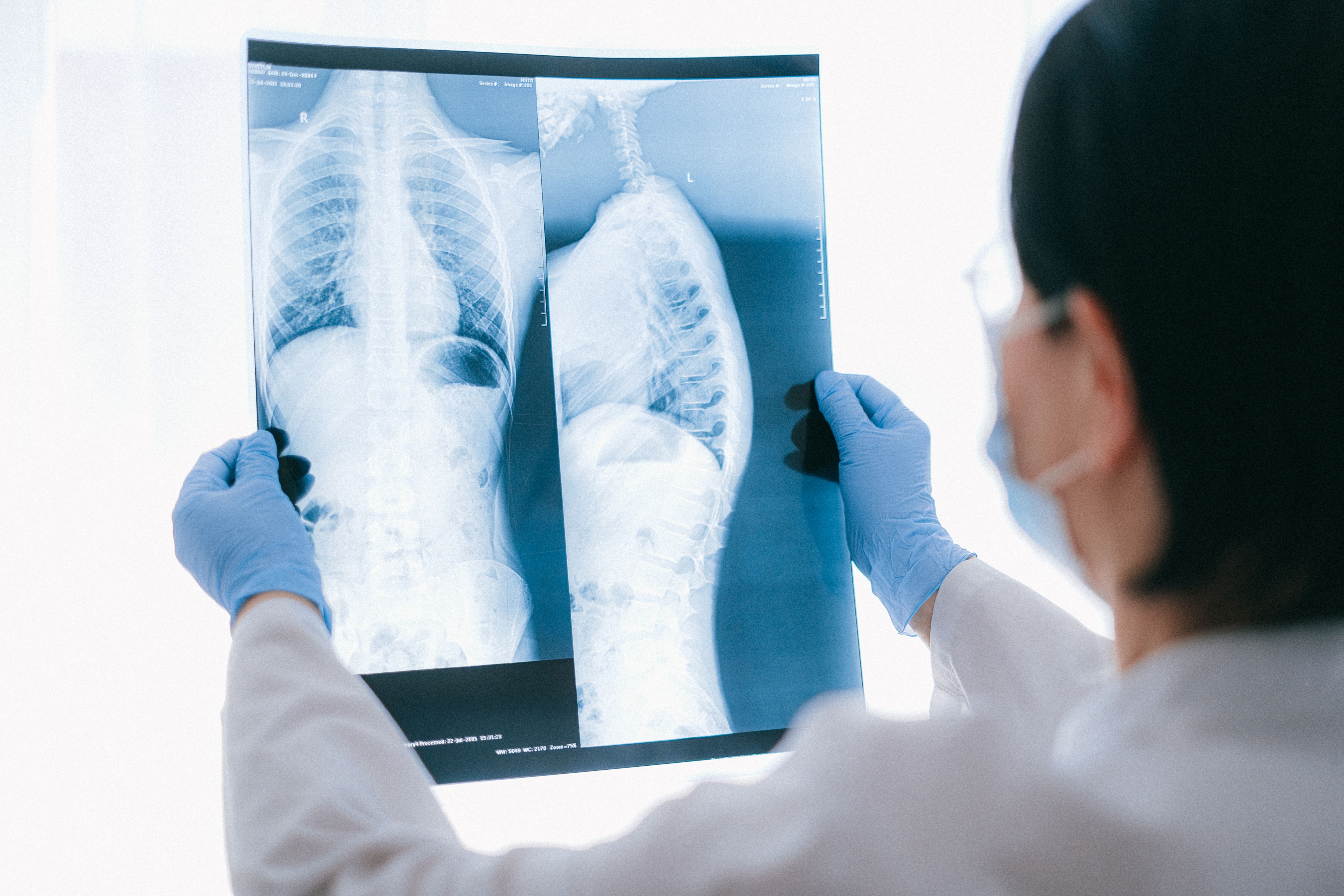 Lung cancers caused by these tumours are more likely to have certain genetic changes, including mutations in the EGFR gene. (Pexel)