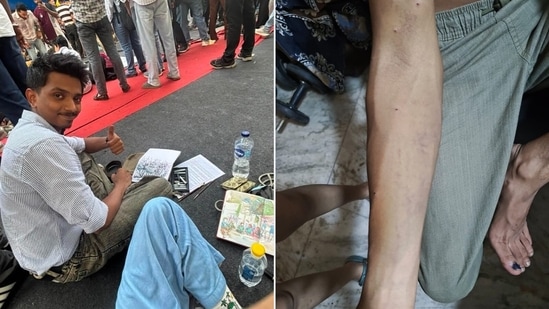 Victim showing his hand where he allegedly received pellet injuries during the clashes. (HT Photo)