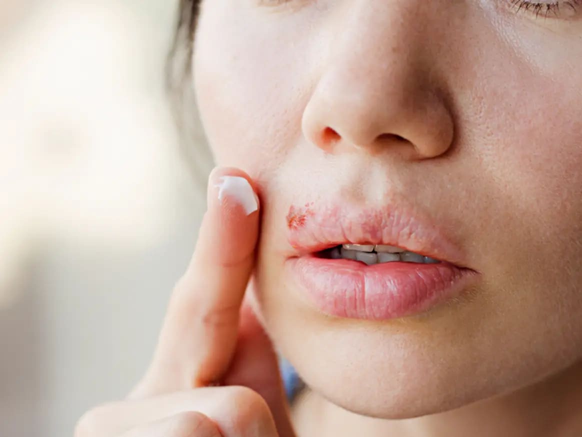 For oral herpes, staying hydrated with cold drinks or sucking on popsicles can soothe painful mouth sores. (Pic: medexpress.co.uk) For oral herpes, staying hydrated with cold drinks or sucking on popsicles can soothe painful mouth sores. (Pic: medexpress.co.uk)