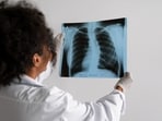 Lung cancer is a type of cancer that starts when abnormal cells grow in an uncontrolled way in the lungs. It is a serious health issue that can cause severe harm and death. (Freepik)