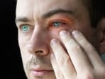 Eyes turned red and inflamed because of conjunctivitis.(Shutterstock)