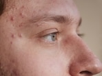 Skin conditions can break out when a person is under stress, shares Dr Kunal Sood. (Pexel)