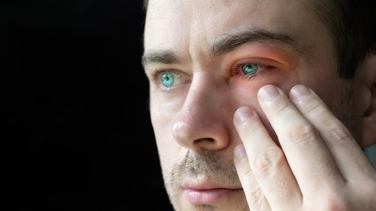 Eyes turned red and inflamed because of conjunctivitis.(Shutterstock)