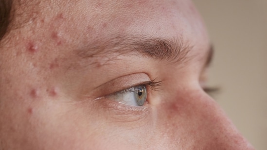 Skin conditions can break out when a person is under stress, shares Dr Kunal Sood.
