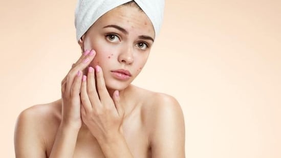 Sensitive skin may even see sudden rise of pimples.