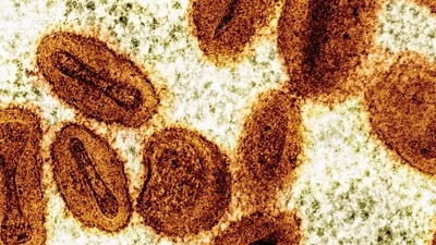 The disease, which was first detected in humans in 1970 in the Democratic Republic of Congo, causes fever, muscular aches and large boil-like skin lesions, and can be deadly. (NIAID via AP)