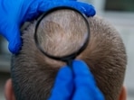 Baldness can indicate any physiological malfunction.