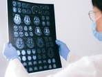 According to Dr. Sunny Jain, concerns about mobile phone radiation causing brain tumours are unfounded.