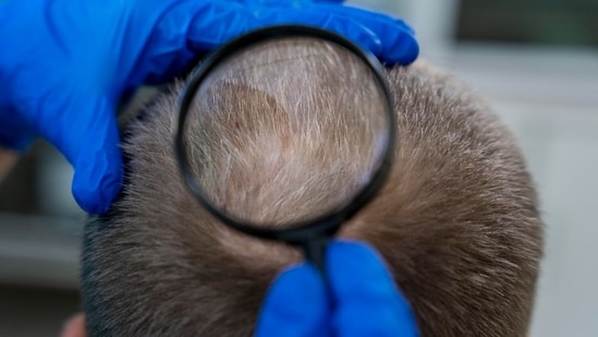 Baldness can indicate any physiological malfunction.