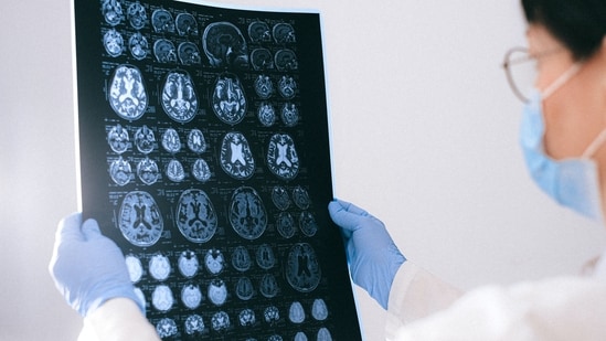 According to Dr. Sunny Jain, concerns about mobile phone radiation causing brain tumours are unfounded. (Pexels)