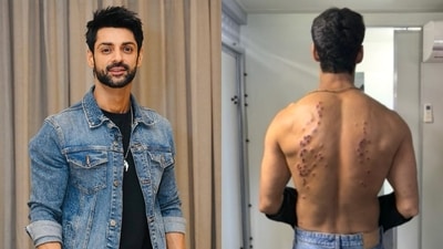Karan Wahi recalls the impact of the Pellet Gun Stunt in Khatron Ke Khiladi 15. Karan Wahi recalls the impact of the Pellet Gun Stunt in Khatron Ke Khiladi 15.