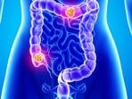 According to Dr Tanvi, ZFP36L2 is part of an emergency repair program in our bodies. 