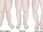Knock knees (on the left) and bow legs (on the right) are leg alignment issues often seen in children. (Pinterest)