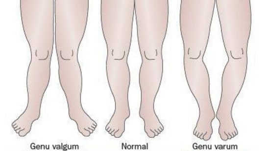 Knock knees (on the left) and bow legs (on the right) are leg alignment issues often seen in children.