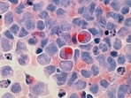 FDA officials gave expedited approval to daraxonrasib, which blocks a mutated protein that fuels tumor growth. (Representational)(Unsplash)