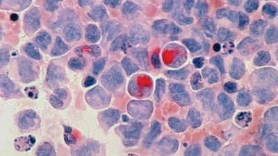 FDA officials gave expedited approval to daraxonrasib, which blocks a mutated protein that fuels tumor growth. (Representational) (Unsplash) FDA officials gave expedited approval to daraxonrasib, which blocks a mutated protein that fuels tumor growth. (Representational) (Unsplash)