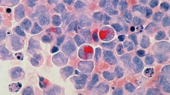FDA officials gave expedited approval to daraxonrasib, which blocks a mutated protein that fuels tumor growth. (Representational)(Unsplash)