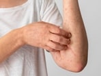 Skin rashes often flare up in monsoon season. (Picture credit: Freepik)