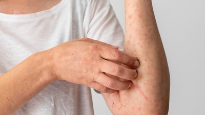 Skin rashes often flare up in monsoon season. (Picture credit: Freepik) Skin rashes often flare up in monsoon season. (Picture credit: Freepik)