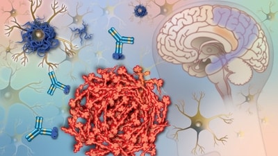 Alzheimer’s disease involves two processes in the brain that unfold over years, often well before symptoms appear. (Representative Image) Alzheimer’s disease involves two processes in the brain that unfold over years, often well before symptoms appear. (Representative Image)