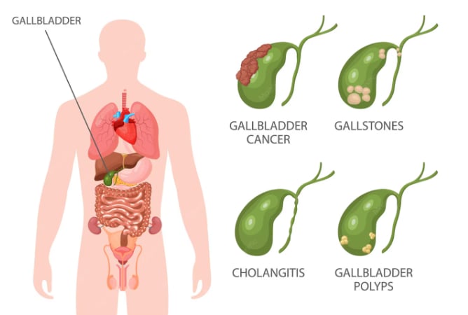 Dr Anupama shared that a gallbladder attack, usually caused by a gallstone blocking the bile duct, typically causes sudden or steady pain in the upper right or upper middle abdomen. (Freepik) Dr Anupama shared that a gallbladder attack, usually caused by a gallstone blocking the bile duct, typically causes sudden or steady pain in the upper right or upper middle abdomen. (Freepik)