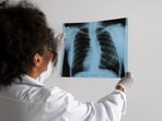 Lung cancer is a type of cancer that starts when abnormal cells grow in an uncontrolled way in the lungs. It is a serious health issue that can cause severe harm and death. (Freepik)