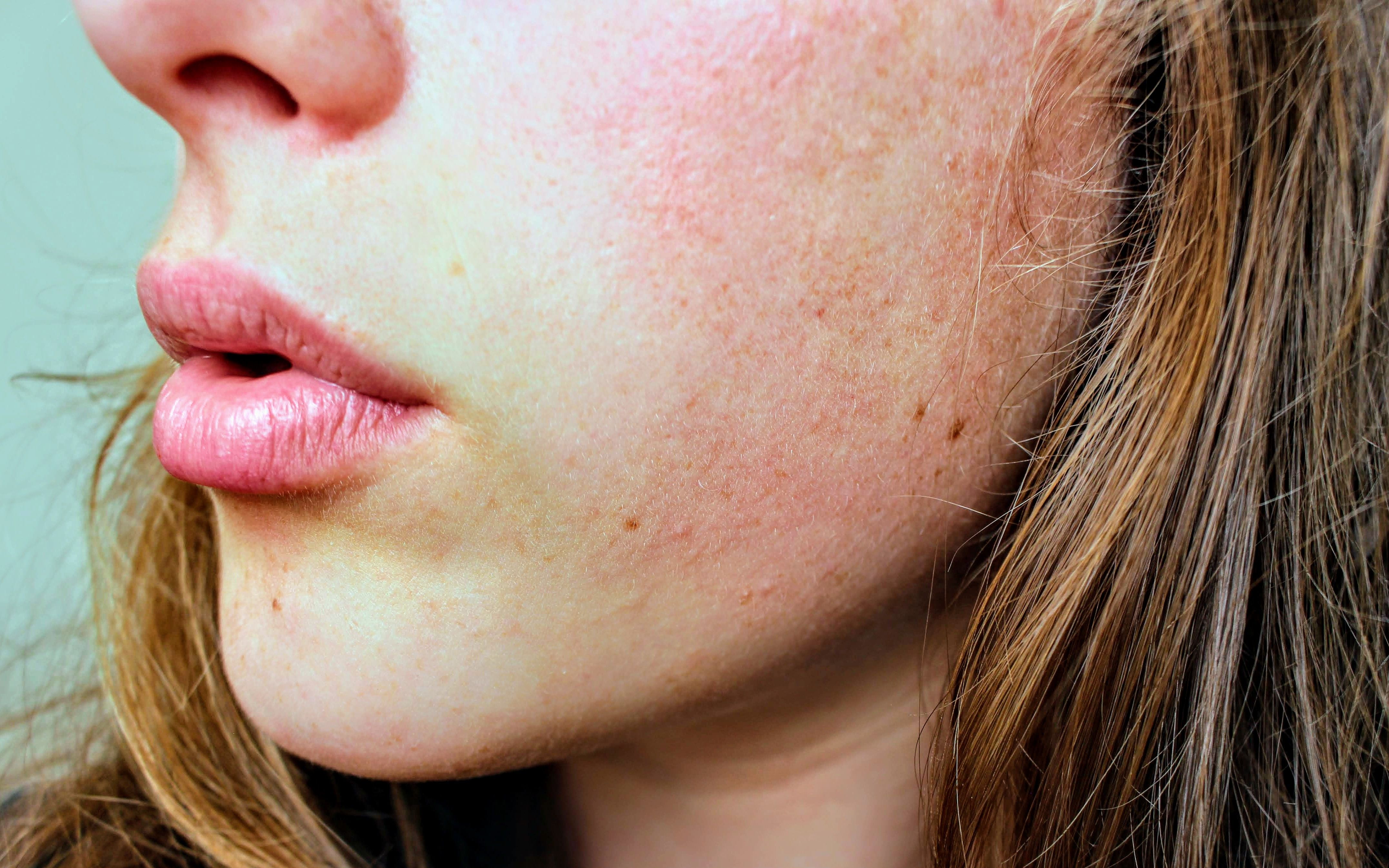 Treating the wrong skin disorder with whatever cream one wishes to try may not only delay the treatment but make it even worse. (Pexel) Treating the wrong skin disorder with whatever cream one wishes to try may not only delay the treatment but make it even worse. (Pexel)