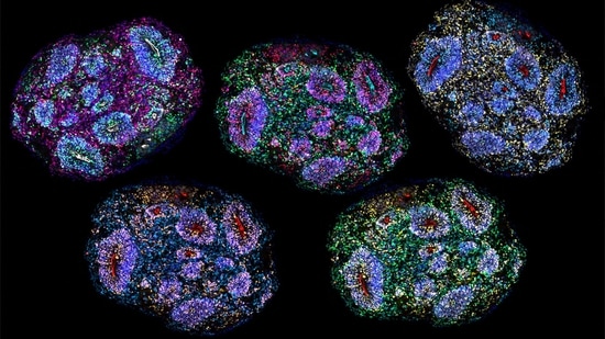 Supreme Court had previously ruled that stem cell therapy for autism cannot be offered as a routine clinical service or commercial treatment.