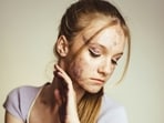 Why your acne scars may need different treatments.(Unsplash)
