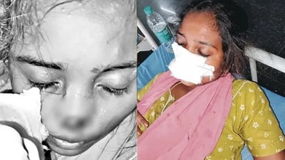 భార్య ముక్కు కొరికిన భర్త భార్య ముక్కు కొరికిన భర్త
