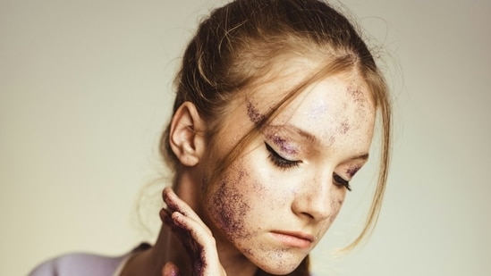 Why your acne scars may need different treatments.(Unsplash)