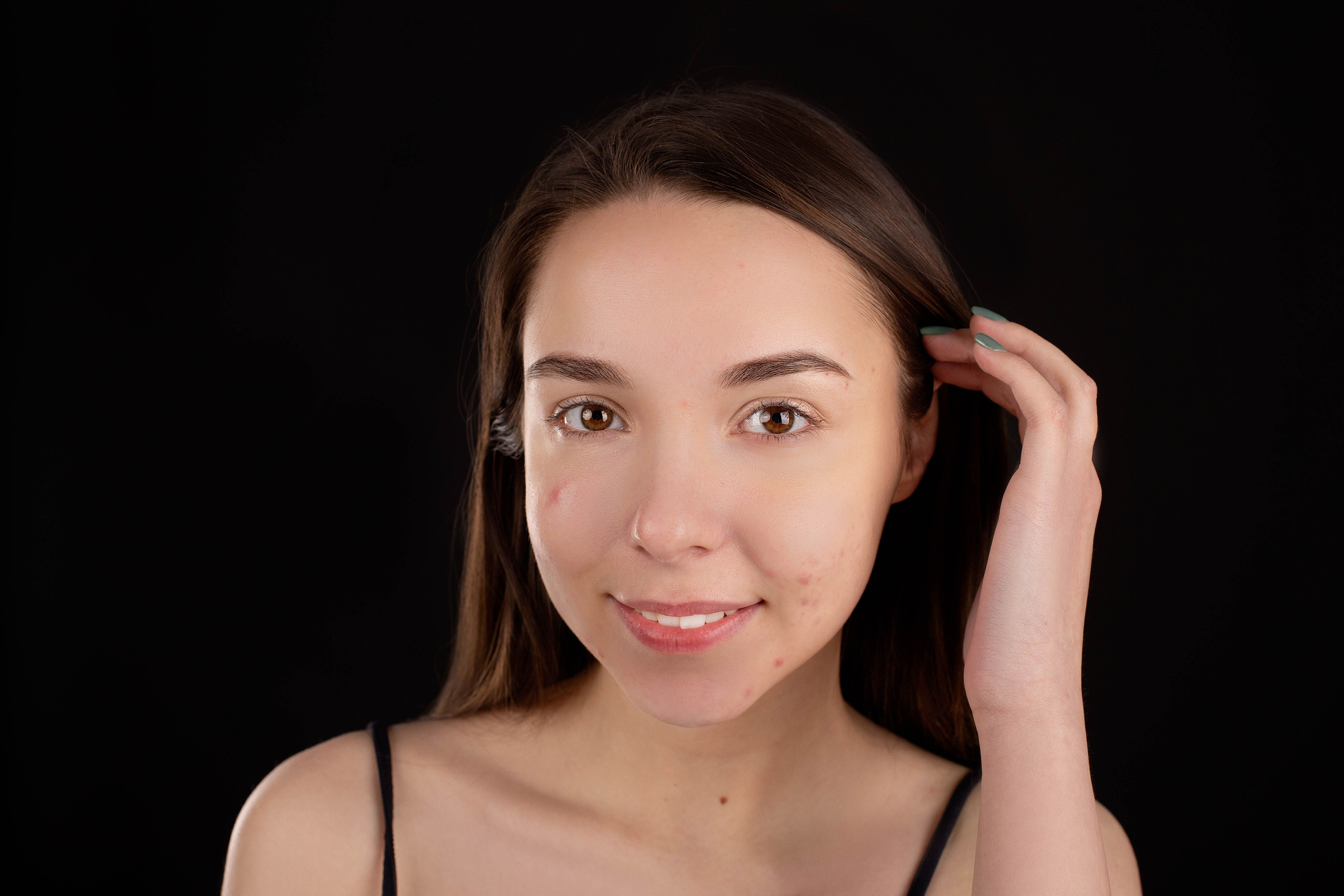 Ice-pick scars are scars with deep pits that go down to the dermis. (Pexel) Ice-pick scars are scars with deep pits that go down to the dermis. (Pexel)