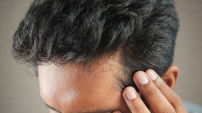 Here’s how genetics, stress, lifestyle and creatine could play a role in hair loss. Here’s how genetics, stress, lifestyle and creatine could play a role in hair loss.