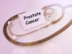A new study published in The Lancet suggests patients of prostate cancer should go in for MRI scan before a biopsy.