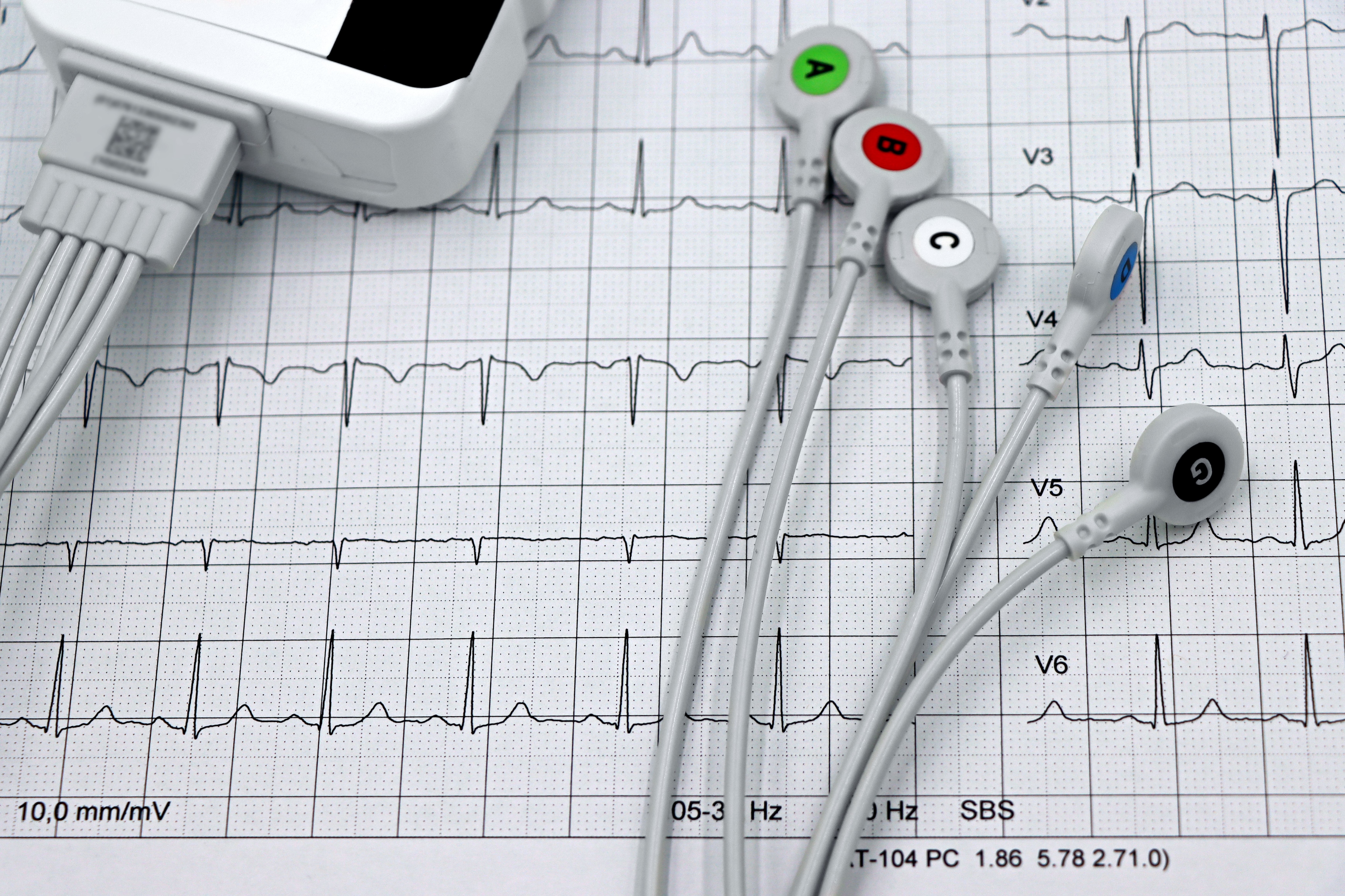ECG shows the heart's electrical activity. (Pexel)
