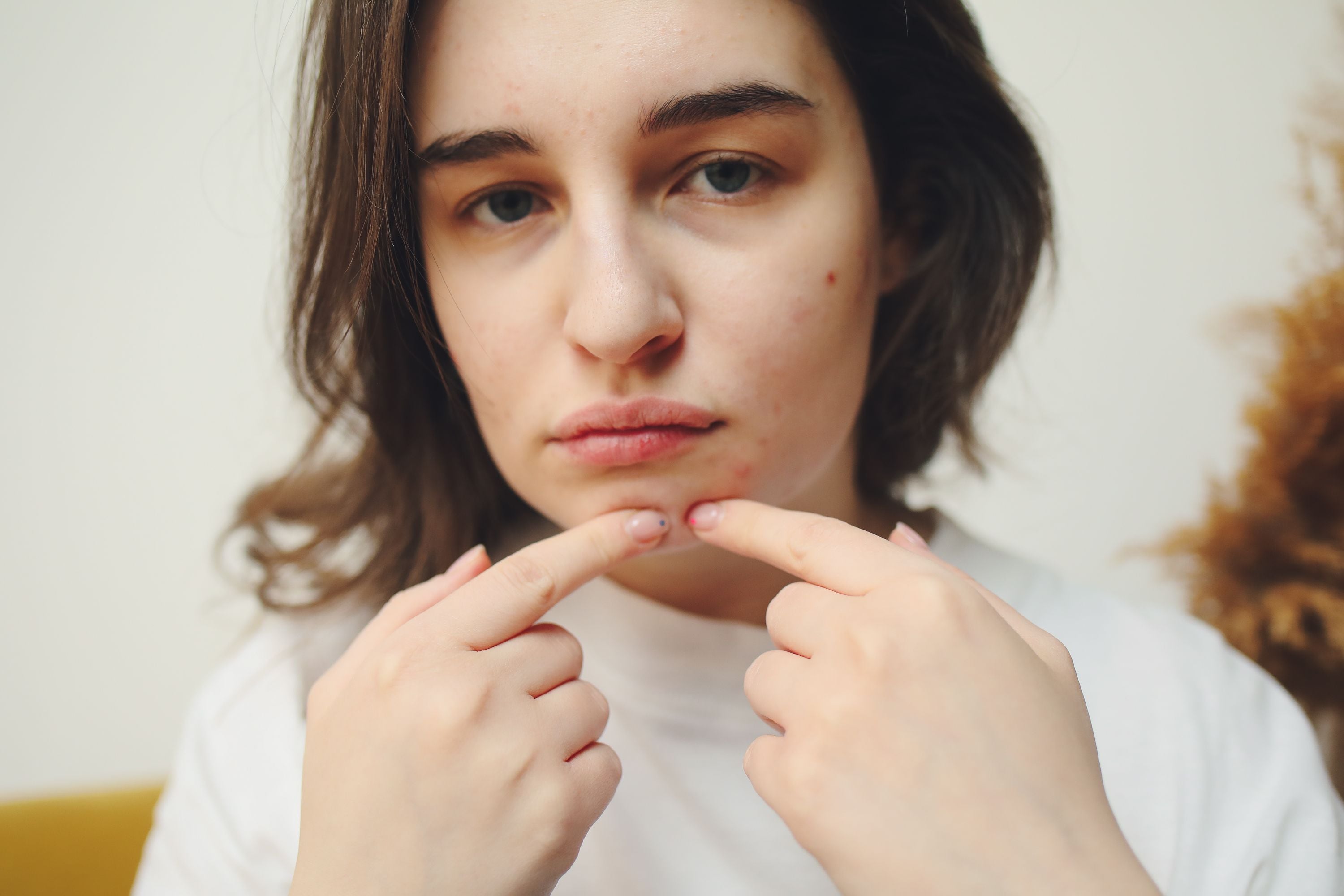 Worsening acne may indicate an allergic reaction to new skincare products. (Pexel) Worsening acne may indicate an allergic reaction to new skincare products. (Pexel)